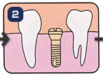 歯の抜けたところへインプラントを植え込んだあと、あごの骨にしっかり固定されるまで、3〜6ヶ月待ちます。